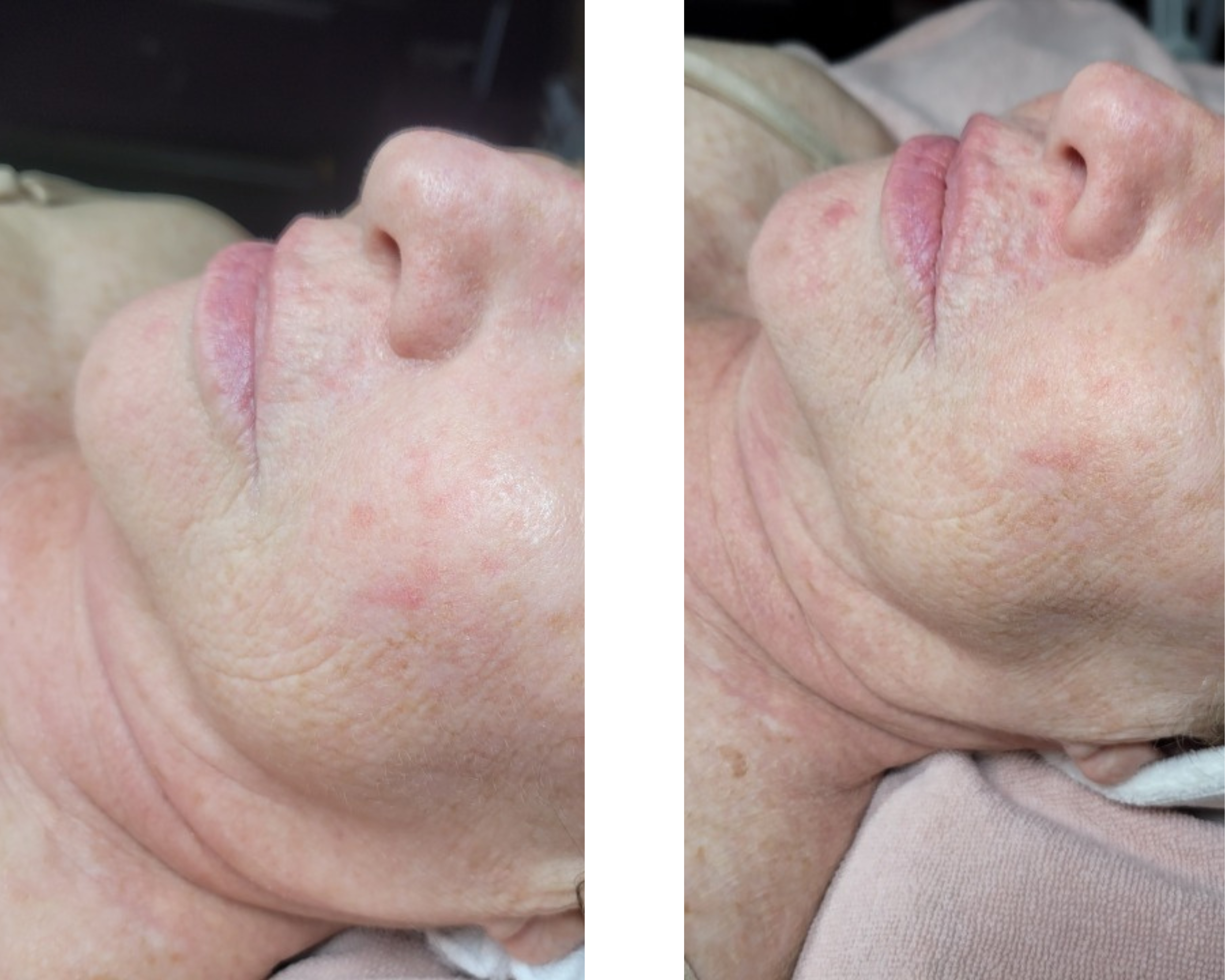 Micro-Needling